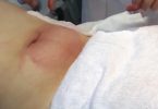 Cryolipolysis