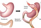 Sleeve-Gastrectomy