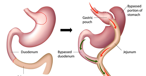 Sleeve-Gastrectomy