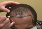 hair-transplant-srugery