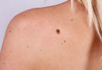 Moles-and-Treatment