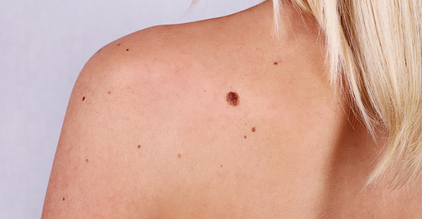 Moles-and-Treatment