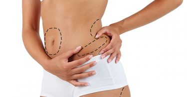 Non-Surgical-Fat-Removal