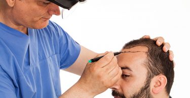 Hair-Transplant-Surgery